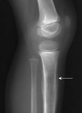 Ewing sarcoma tibia child (cropped).jpg