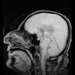 Archivo:NPH MRI 272 GILD