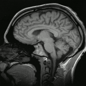 Imágenes de una cabeza humana obtenidas por resonancia magnética (vista sagital).