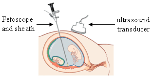 Fetal-endoscope.gif