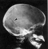 Archivo:Skull Fracture X-ray