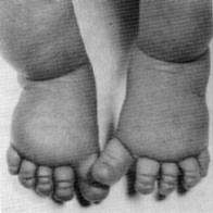 Archivo:Puffy feet
