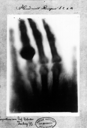 Archivo:First medical X-ray by Wilhelm Röntgen of his wife Anna Bertha Ludwig's hand - 18951222