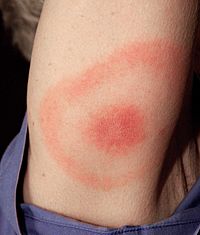 Archivo:Erythema migrans - erythematous rash in Lyme disease - PHIL 9875