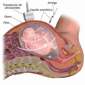 Archivo:Amniocentesis-es