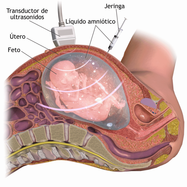 Amniocentesis-es