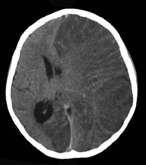 Archivo:CT scan Rasmussen's encephalitis