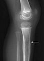 Ewing sarcoma tibia child (cropped)