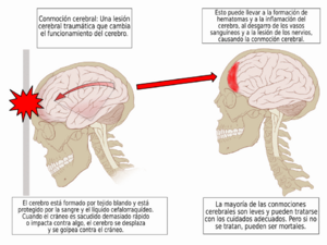 Archivo:Concussion Anatomy-es