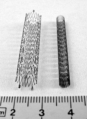 Archivo:Stent4 (fcm)