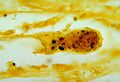 Leptospirosis in kidney