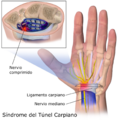 Carpal Tunnel Syndrome-es