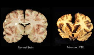 Chronic Traumatic Encephalopathy.png