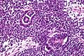 Wilms tumour - very high mag