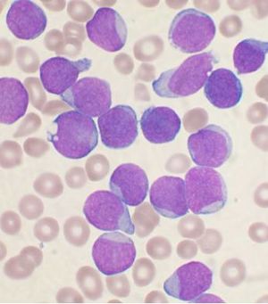 Archivo:Acute leukemia-ALL