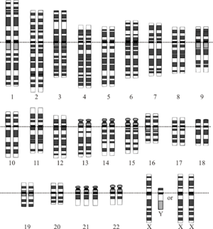 Down Syndrome Karyotype.png