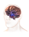 Pituitary Tumor