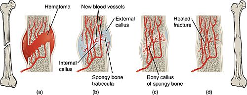 Archivo:613 Stages of Fracture Repair
