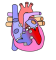 Heart tetralogy fallot