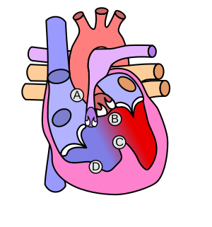 Archivo:Heart tetralogy fallot