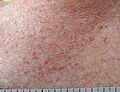 Pruritic rash COVID