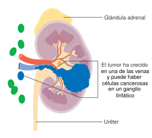 Diagram showing stage 3 kidney cancer CRUK 222-es