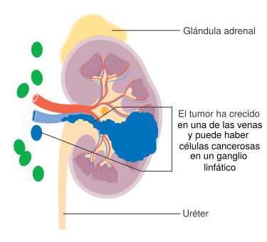 Archivo: Diagram showing stage 3 kidney cancer CRUK 222-es