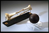 Archivo:Cannonball Fracture of the Femur 1863