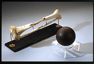 Archivo:Cannonball Fracture of the Femur 1863