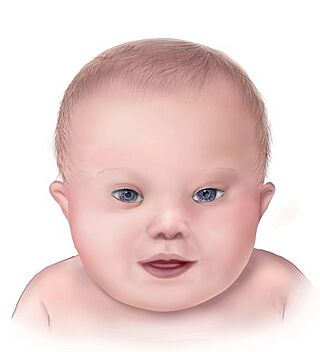 Down syndrome lg.jpg
