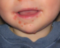 Hand Foot Mouth Disease