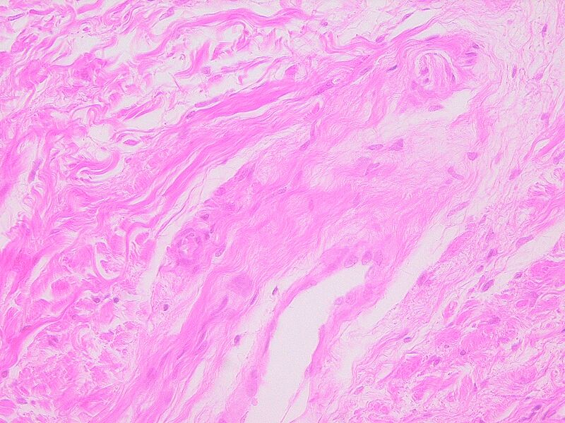 Dense irregular