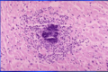 Miocarditis tambien llamado endocarditis viral o bacteriana