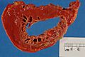Myocardial infarction (old)
