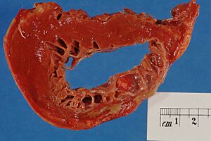 Archivo:Myocardial infarction (old)