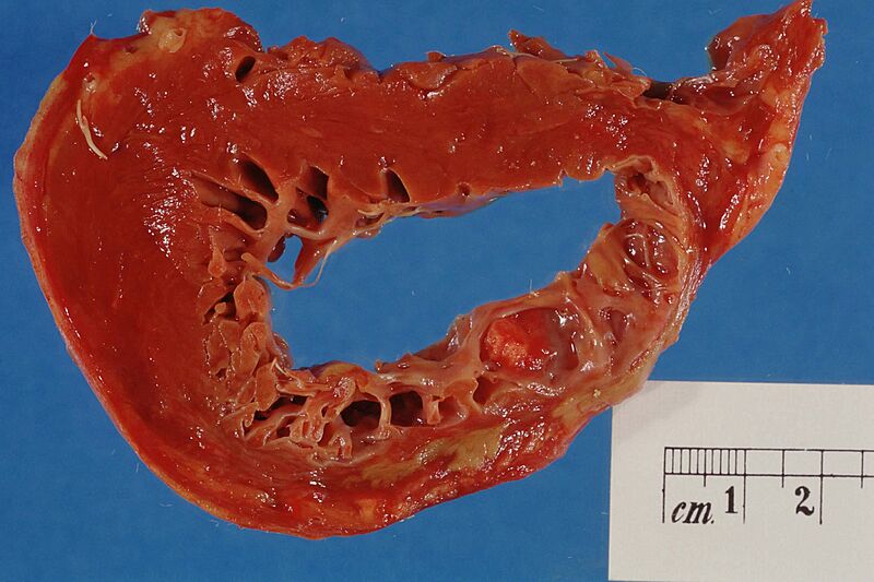 Myocardial infarction (old)