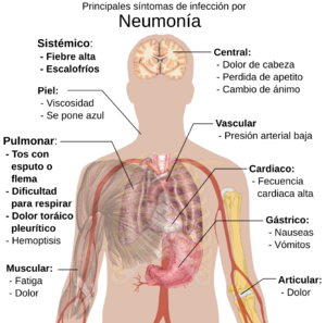 Principales síntomas de la neumonía infecciosa.