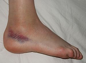 Archivo:Sprained foot