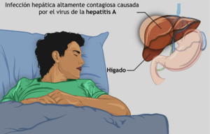 Archivo:A young boy suffering from Hepatitis-A-es