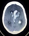 Intracerebral hemorrage (CT scan)