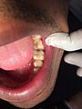 Dental Caries Lower Left First Molar 01