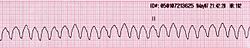 Archivo:Lead II rhythm ventricular tachycardia Vtach VT