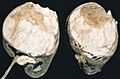 Wilms tumor