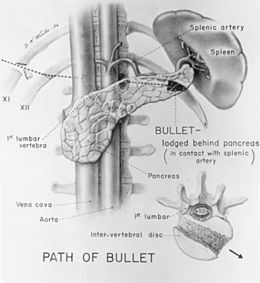 Archivo:Path of Bullet that wounded President James A. Garfield - Duncan K. Winter drawing - NCP 001860