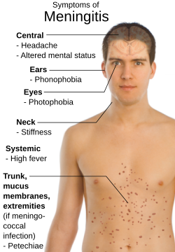 Archivo:Symptoms of Meningitis
