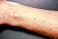 Schistosomiasis itch