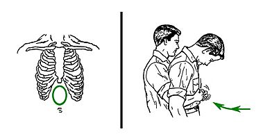 Archivo:Abdominal thrusts against choking