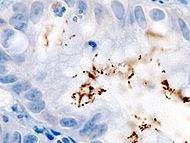 Archivo:Immunohistochemical detection of Helicobacter pylori histopathology