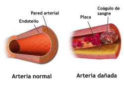 Archivo:Blausen 0053 Artery NormalvsDiseasedVessel-es