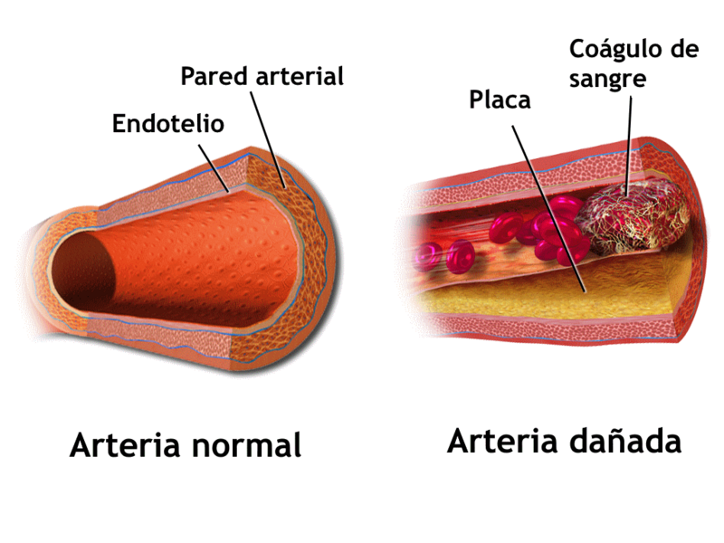Blausen 0053 Artery NormalvsDiseasedVessel-es